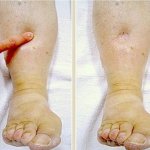 swollen-legs1-300x300.jpg